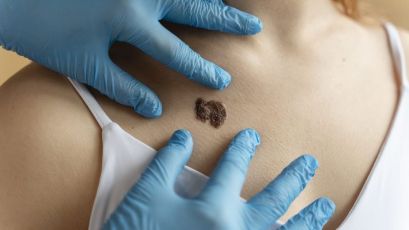PERÚ: ESTADO APRUEBA TRATAMIENTO PARA MELANOMA, PERO PACIENTES SIGUEN SIN PODER ACCEDER