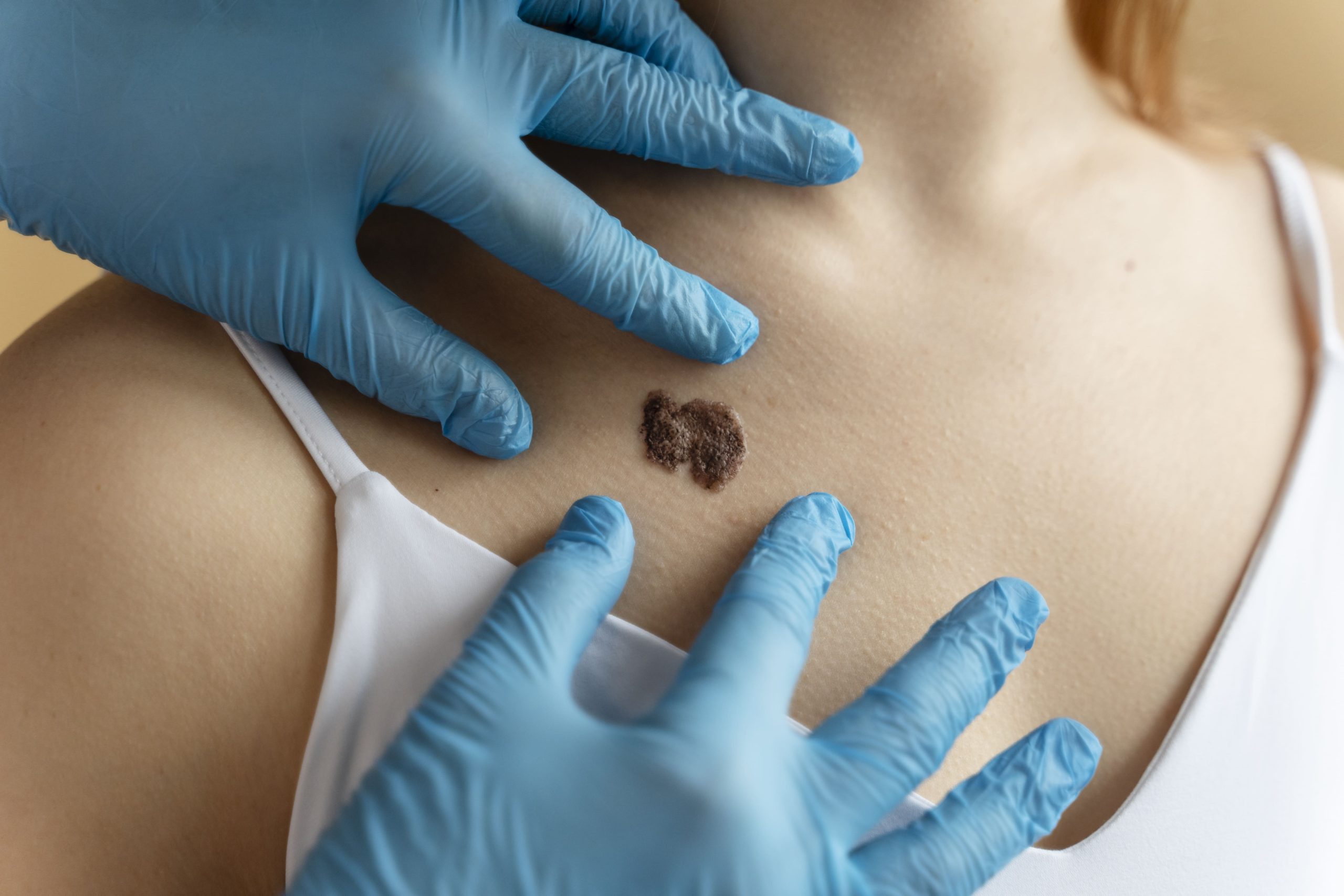 PERÚ: ESTADO APRUEBA TRATAMIENTO PARA MELANOMA, PERO PACIENTES SIGUEN SIN PODER ACCEDER